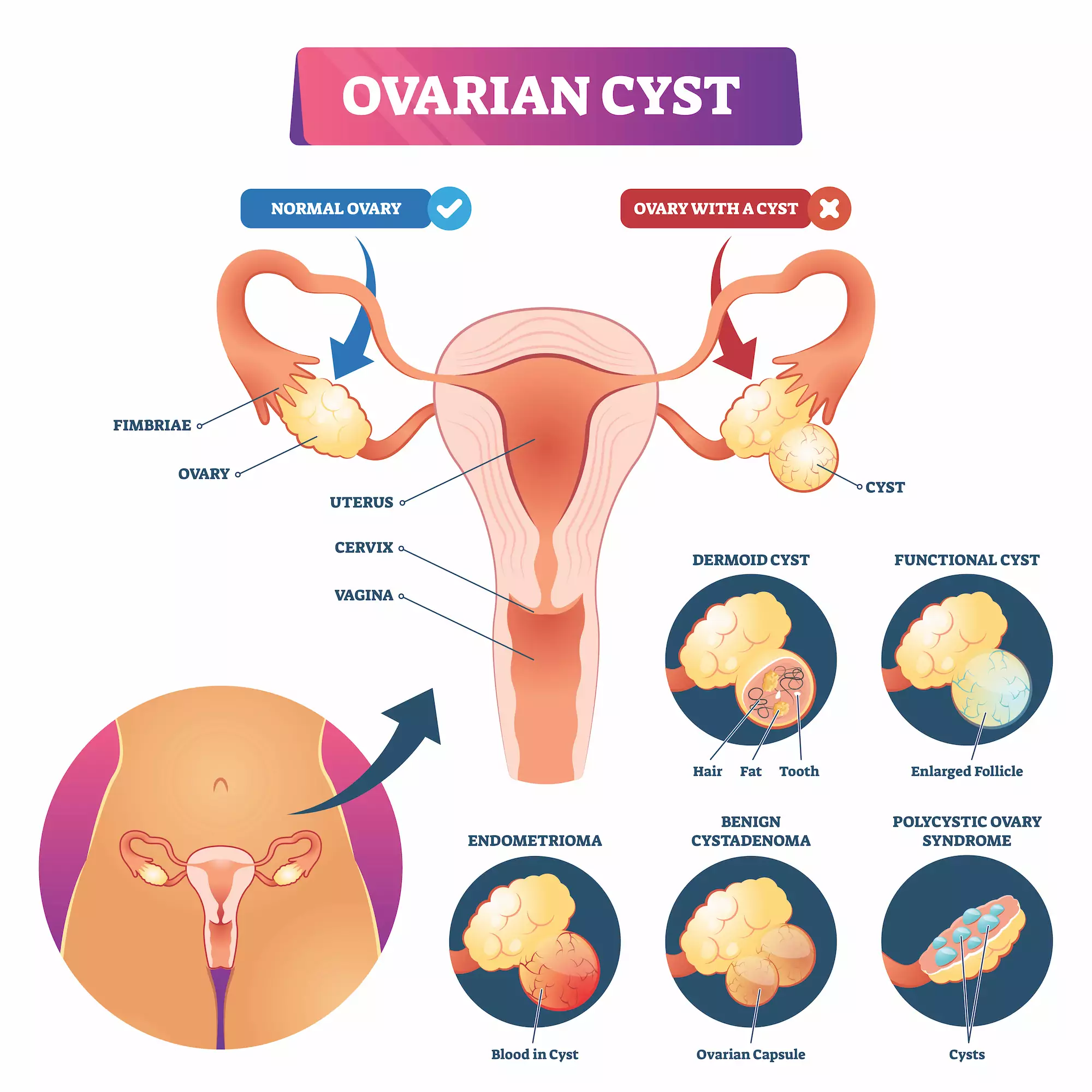 Diagram of different types of ovarian cysts