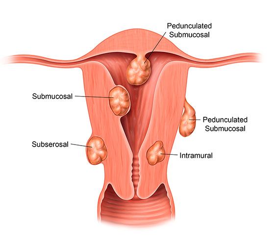 fibroids-vs-cysts-what-s-the-difference-responsum-for-fibroids