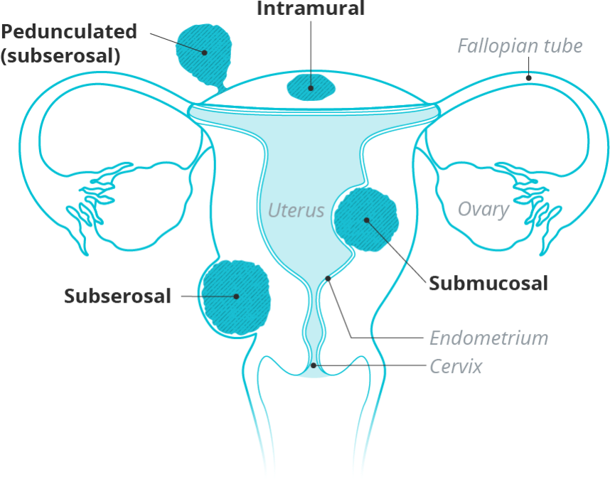 What Is A Subserosal Fibroid Responsum For Fibroids