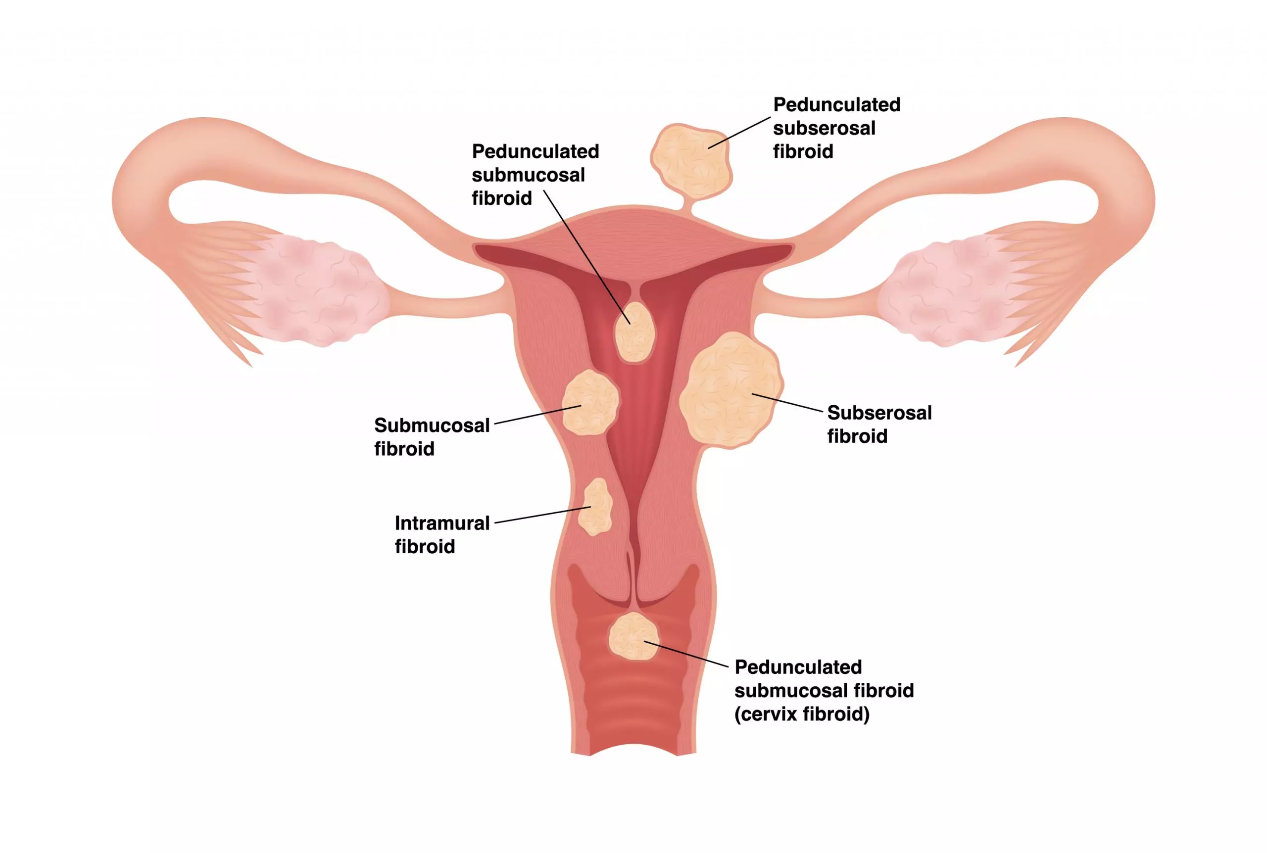 Illustration of the different types of uterine fibroids