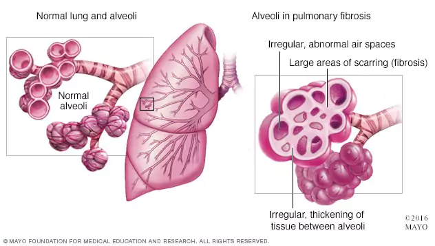 polmone sano vs. polmone con fibrosi polmonare